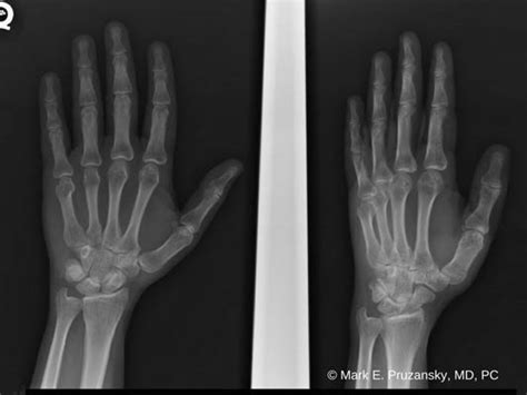 Boxer's Fracture | New York, NY | HandSport Surgery Institute