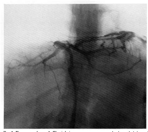 Figure 2 From Obstruction Of The Inferior Vena Cava In The Hepatic