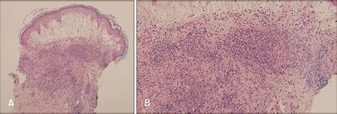 Giant Cellulitis Like Sweet Syndrome Following Varicose Vein Surgery A