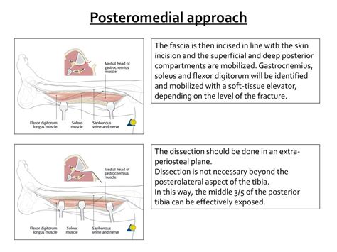 Ppt Surgical Approaches Powerpoint Presentation Free Download Id