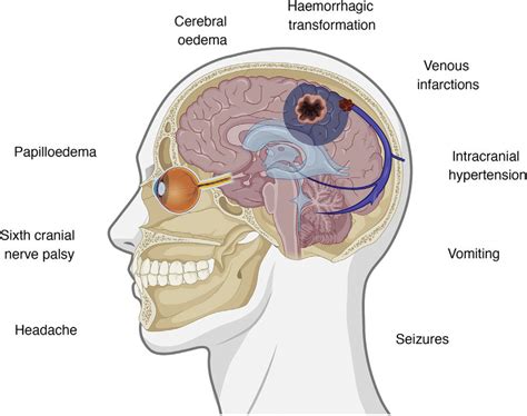 Symptoms and pathophysiological events involved in cerebral venous ...