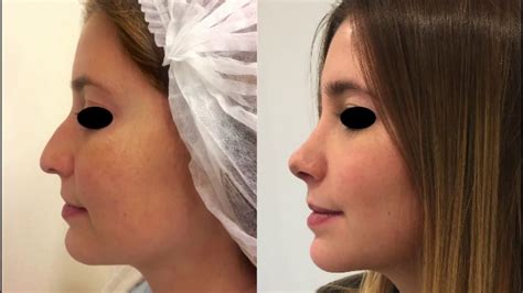 Rinoplastia Antes Y Despues Ideaaro