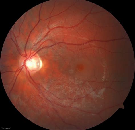 Spontaneous Resolution Of Serous Macular Detachment And Outer Retinal