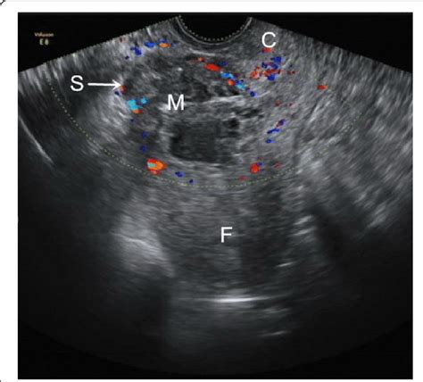 Transvaginal Ultrasonography Of The Patient With Caesarean Scar