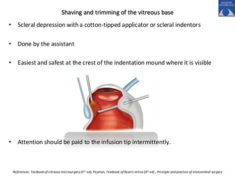 Vitrectomy Development And Steps