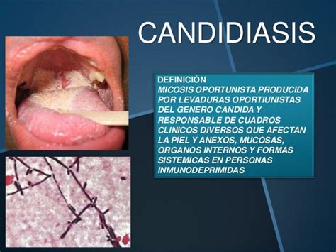 Micosis De Importancia Odontologica