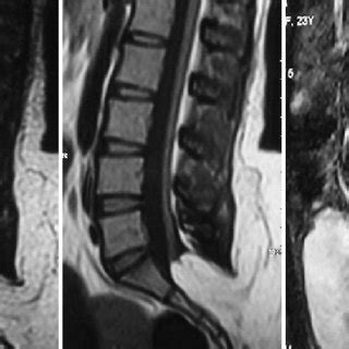 Magnetic Resonance Imaging Lumbar Spine Showing Low Lying Cord And