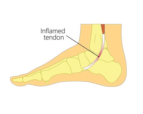 Posterior Tibial Tendonitis | Upswing Health