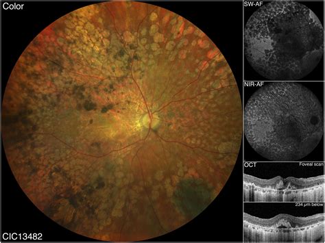 Blindness Incidence for Aggressive Adult-Onset Macular Atrophy Explored