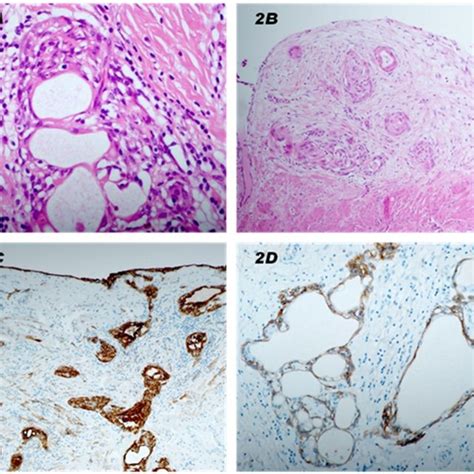 Detail Of The Dilated Tubular Structures With Epithelioid Flattened And Download Scientific