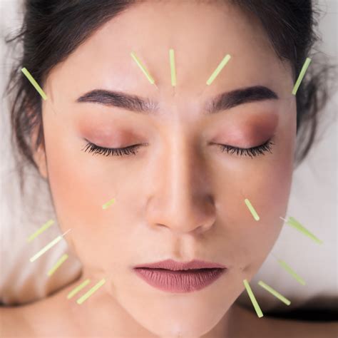 Cosmetic Acupuncture Facial Cupping And Facial Gua Sha