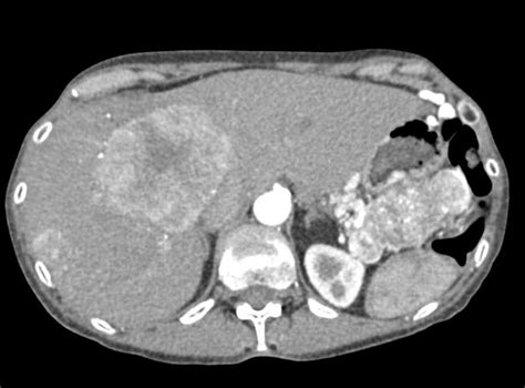 Metastatic Neuroendocrine Tumor Of The Tail Of The Pancreas With Liver