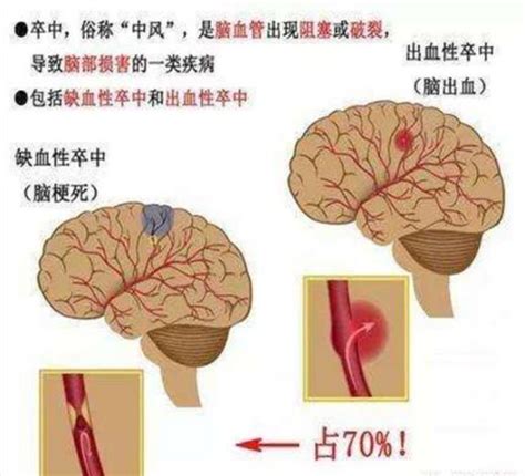 急性缺血性腦卒中的診斷和治療——鄭州大學第一附屬醫院神經介入科 郭新賓 每日頭條