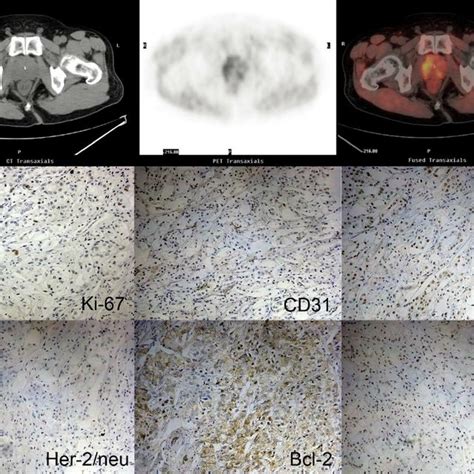 11C Choline PET CT Images And Immunohistochemistry Images Form Patient