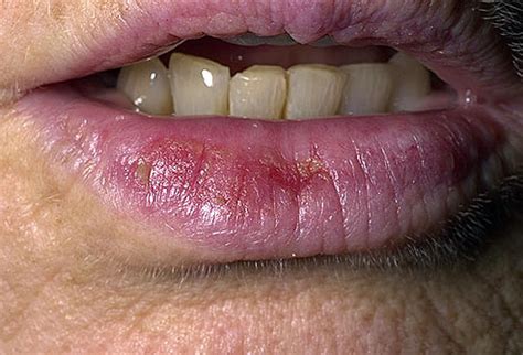 Doctors Gates Actinic Keratosis Actinic Cheilitis