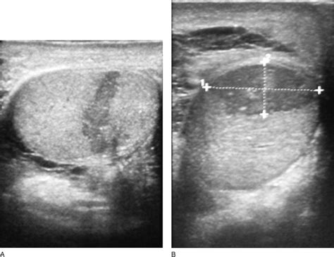 A Rare Case Of Segmental Testicular Infarction Urology