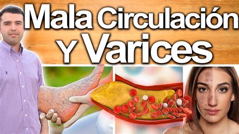 Tienes Várices Y No Las Ves Síntomas Y Signos De Mala Circulación Dolor Punzadas