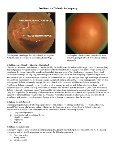 Proliferative Diabetic Retinopathy