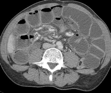 Signo del remolino en el vólvulo intestinal Diagnostico911 org