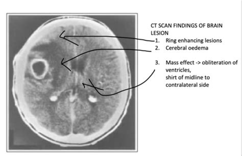 L Meningitis Encephalitis And Brain Abscess Flashcards