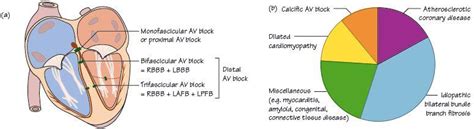 Atrioventricular block – third degree (complete) heart block | Thoracic Key