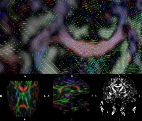 Dtmri Diffusion Tensor Mri Visualization In The D Slicer