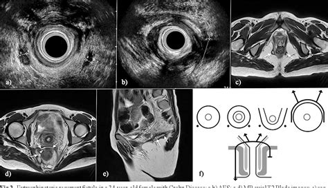 Table I From A Novel Template For Anorectal Fistula Reporting In Anal