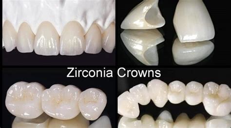 Implant Crown Types: How to choose the best implant crown ...