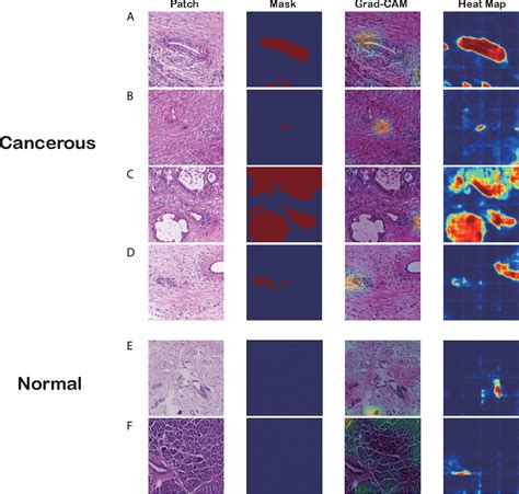 Frontiers Automatic Pancreatic Ductal Adenocarcinoma Detection In