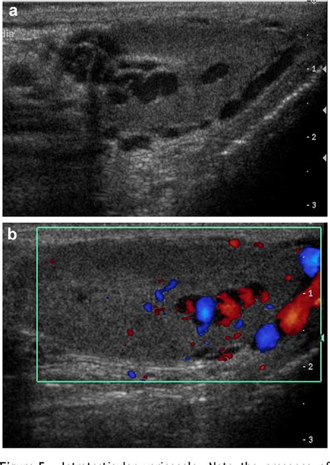 Cystic Lesions And Scrotal Fluid Collections In Adults Ultrasound