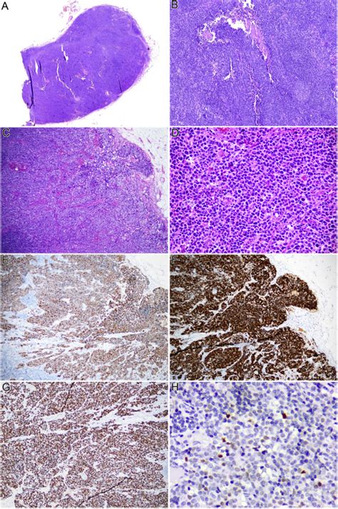 Desmoplastic Small Round Cell Tumour Presenting As Cervical Lymph Nodes