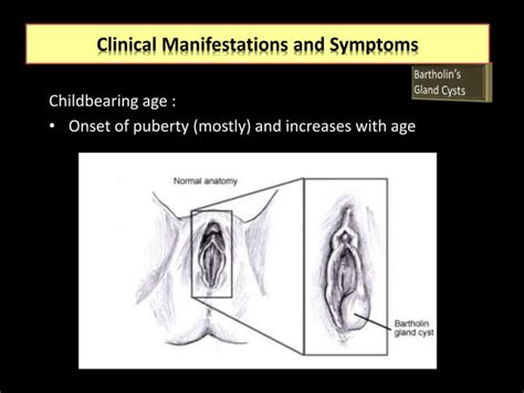 Bartholin Gland Cyst Ppt