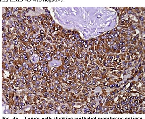 Figure From Soft Tissue Myoepithelial Carcinoma Semantic Scholar