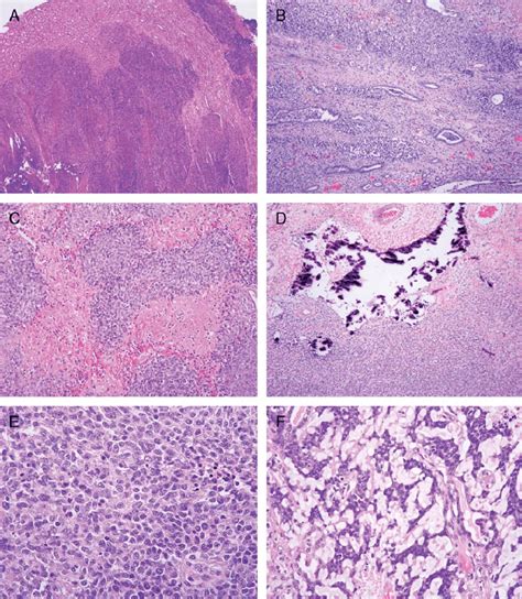 Characteristic Infiltrative Growth Pattern Of Tumor At Margin A And Download Scientific