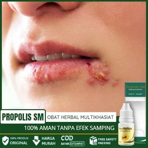 Jual Obat Angular Cheilitis Luka Di Sudut Bibir Peradangan