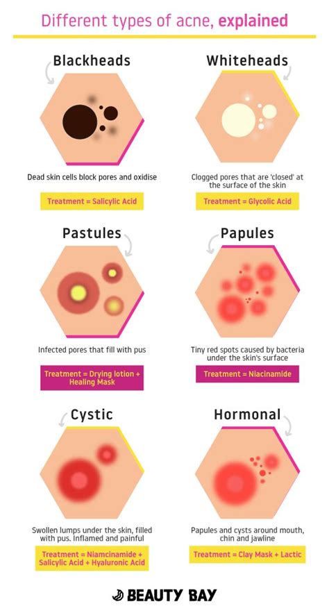 Different types of acne explained – Artofit