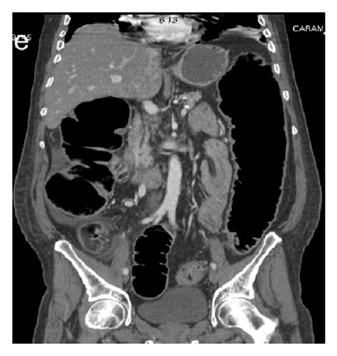 Enteroenteric Ileoileal Intussusception Secondary To Colic