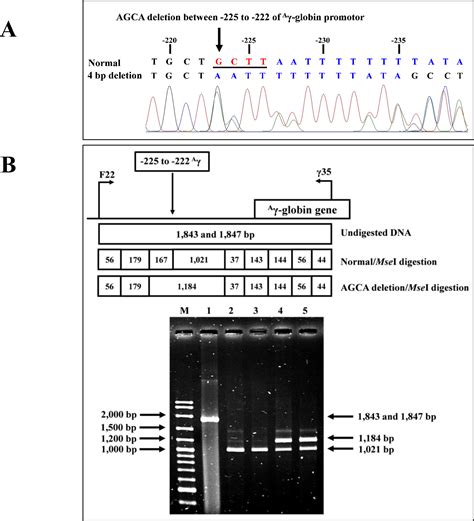 Molecular Basis Of A High Hb A Hb F Thalassemia Trait A