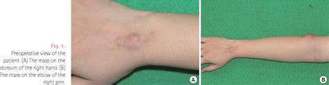 Figure 1 From Iatrogenic Calcinosis Cutis Of The Upper Limb Arising