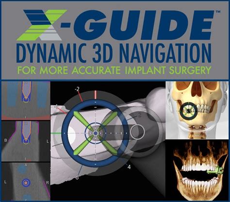 X Guide Dynamic 3d Navigation System Nacogdoches Tx Oral And Facial