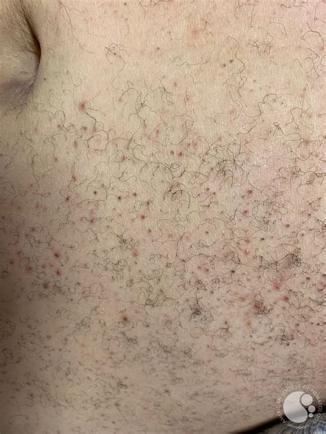 Perifollicular Hemorrhages With Corkscrew Appearance Of Hair