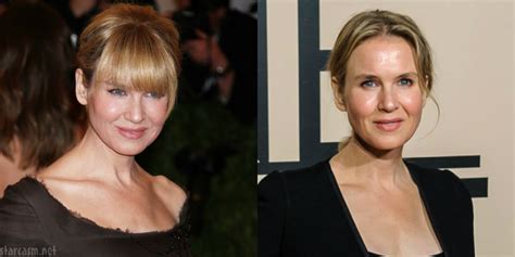 Before And After Did Renee Zellweger Have Plastic Surgery