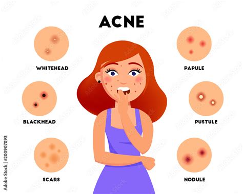 Acne Types Infographic Elements Vector Flat Illustration Girl With