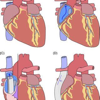 Bidirectional Glenn Tricuspid Atresia