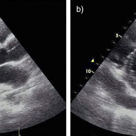 Transthoracic Echocardiogram At The Initial Visit A Parasternal Left