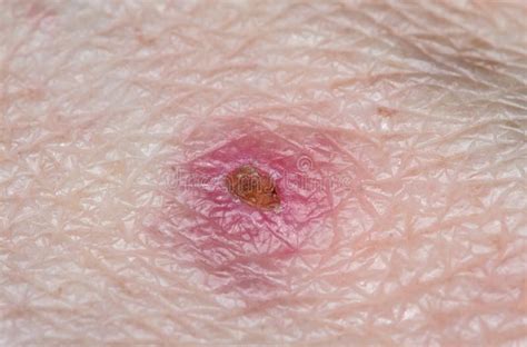 Infected Insect Bite Stock Photo Image Of Dermatology