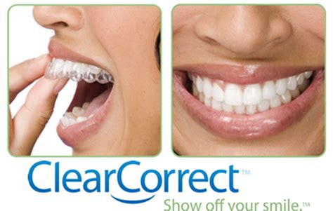 Why We Use Clearcorrect Versus Any Other Aligners Dentist In Leeds