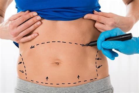 Tummy Tuck Magic Aesthetic Pour Les Op Rations Cosm Tiques