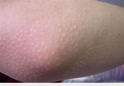 Clinical Photograph Of The Elbow Showing Follicular Papules Download