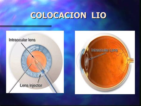 Enfermeria En Cirugia Oftalmologica De Facoemulsificacion CICAT SALUD